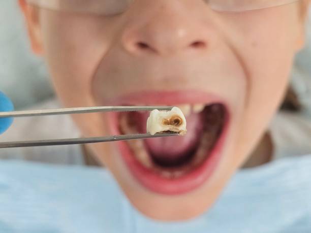 Best Emergency Dentist for Lost Fillings or Crowns in Surfside, FL